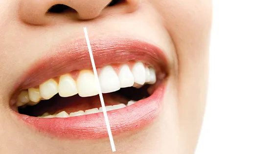 Faceta de Resina: Transforme Seu Sorriso com Naturalidade