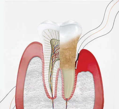 Tratamento Periodontal