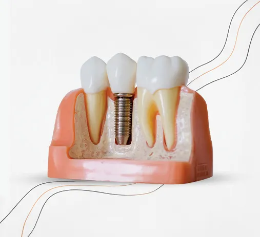Implantes Dentários