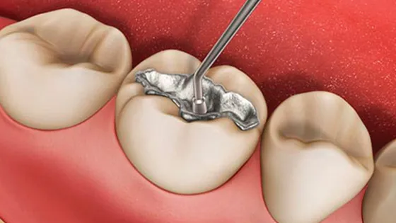 Troca de Amálgama: um sorriso mais belo e saudável.